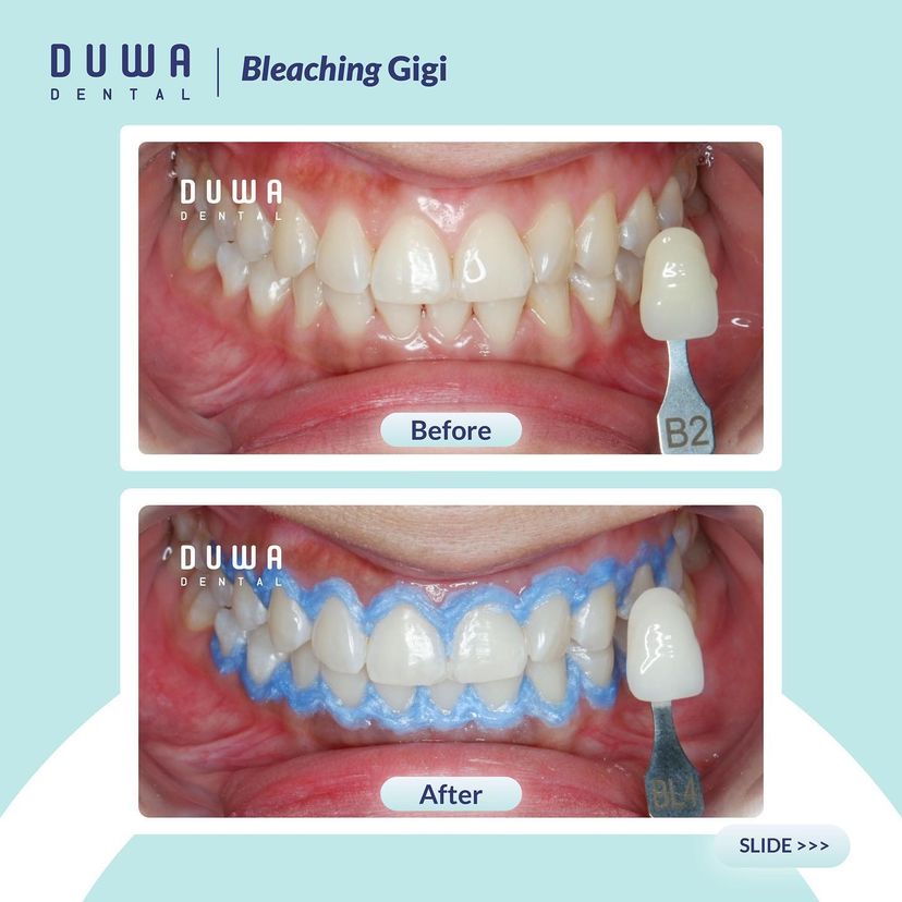 Bleaching Gigi