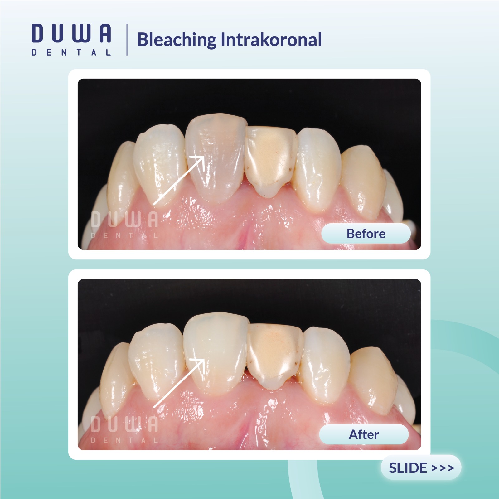 Bleaching Intrakoronal