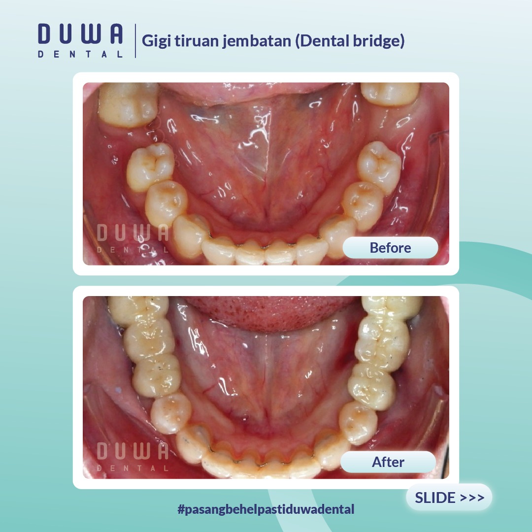 Dental Bridge (Gigi Tiruan Jembatan)