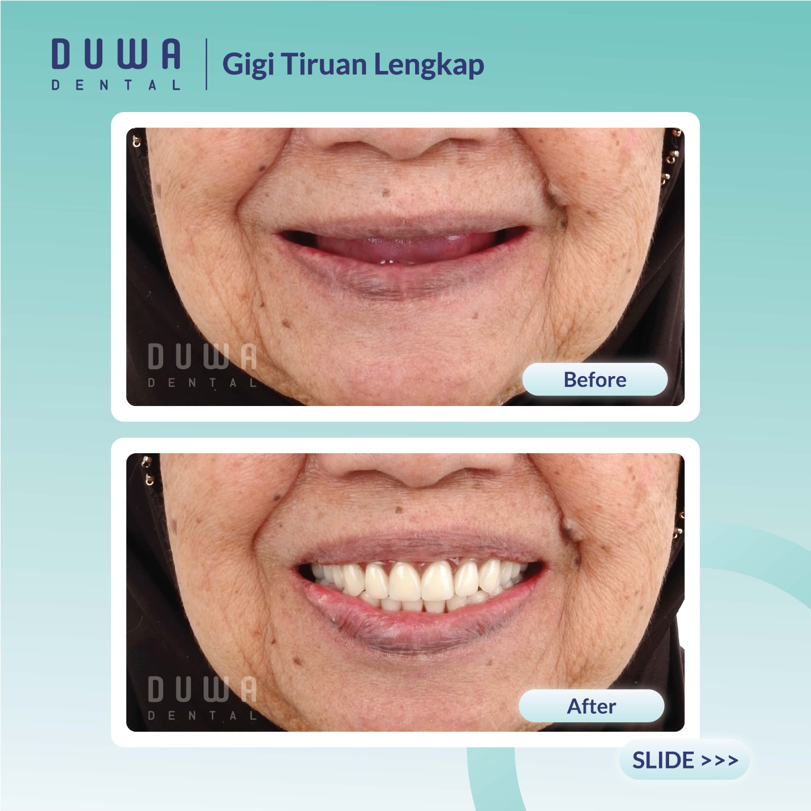 Gigi Tiruan Lengkap