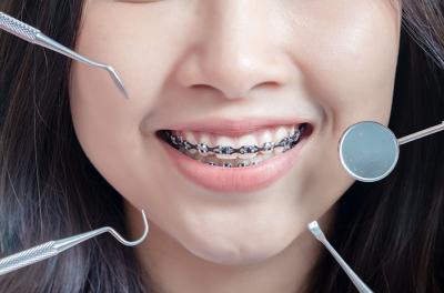 Ini Dia Perbedaan Antara Behel Konvensional Dan Self Ligating
