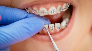 Apakah Pasang Behel Itu Sakit? Ini Penjelasannya!