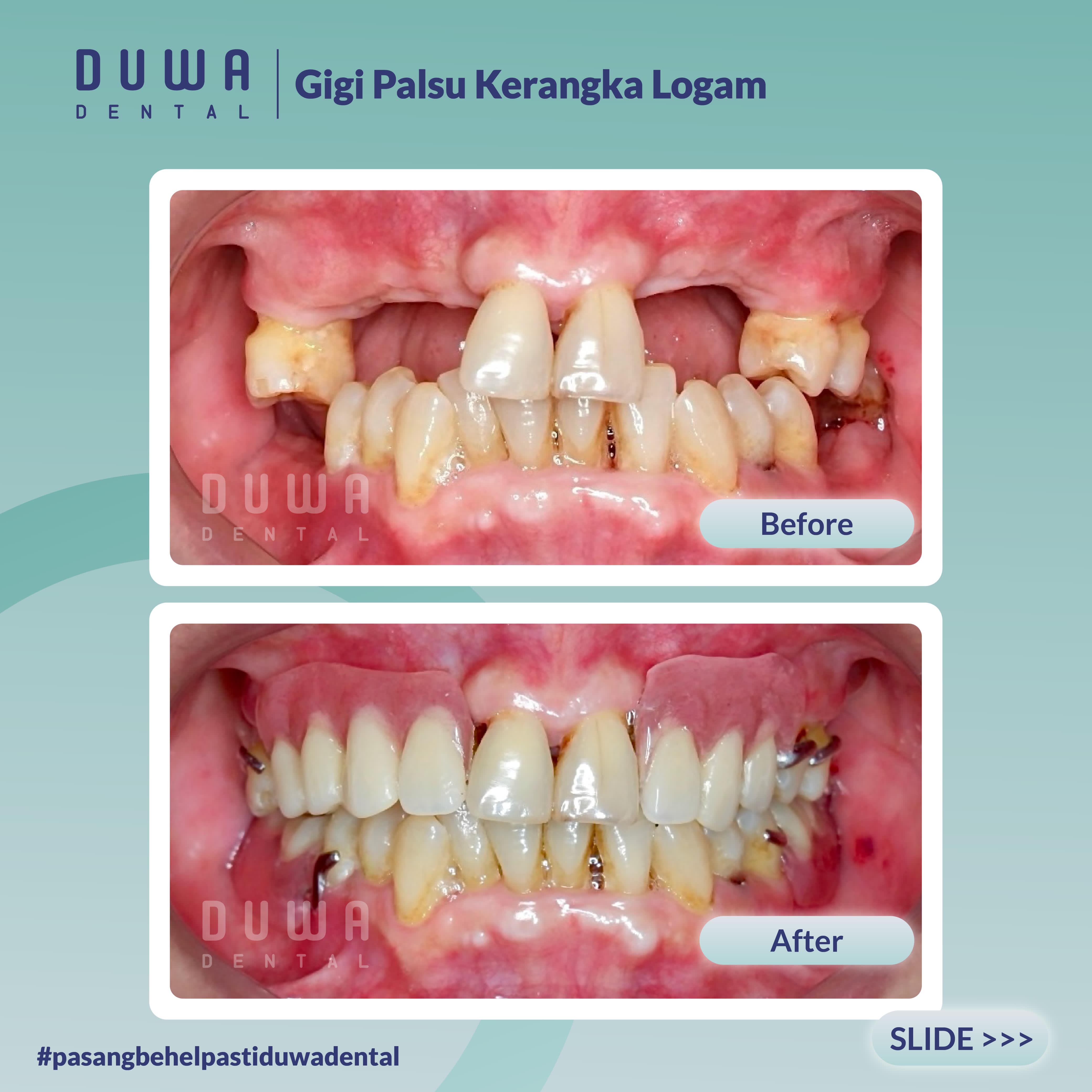 Gigi Palsu Kerangka Logam