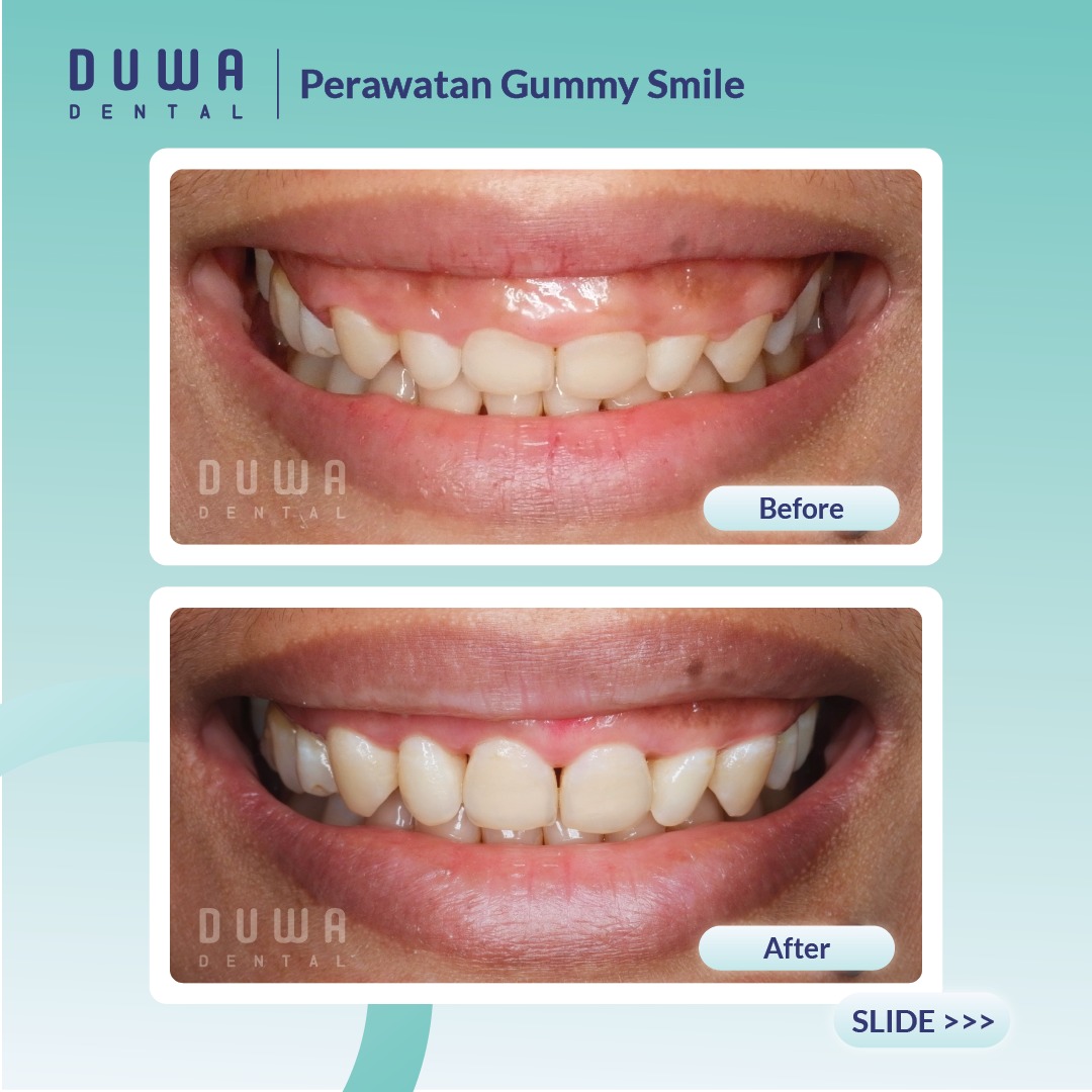 Perawatan Gummy Smile