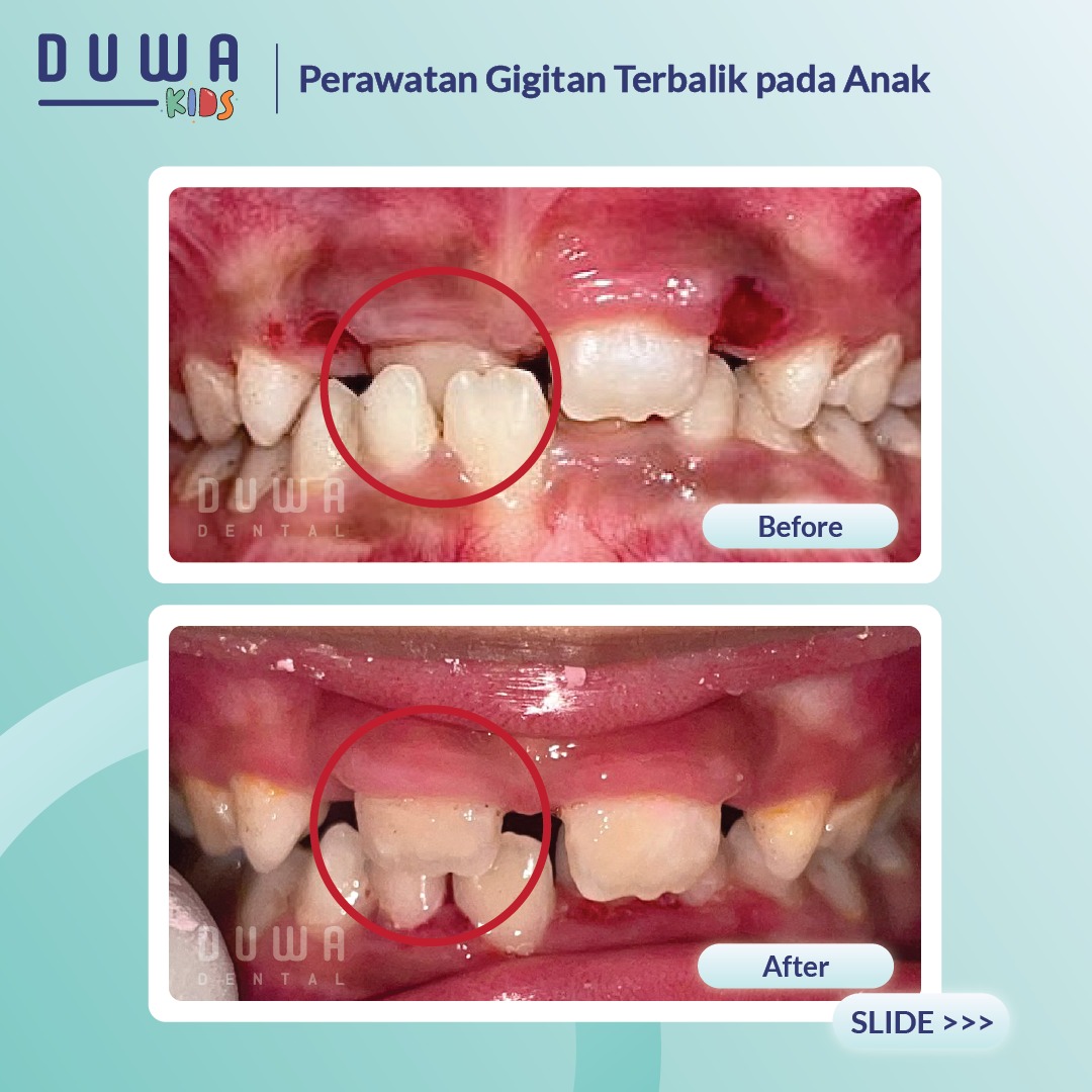 Perawatan Gigi Anak Terbalik
