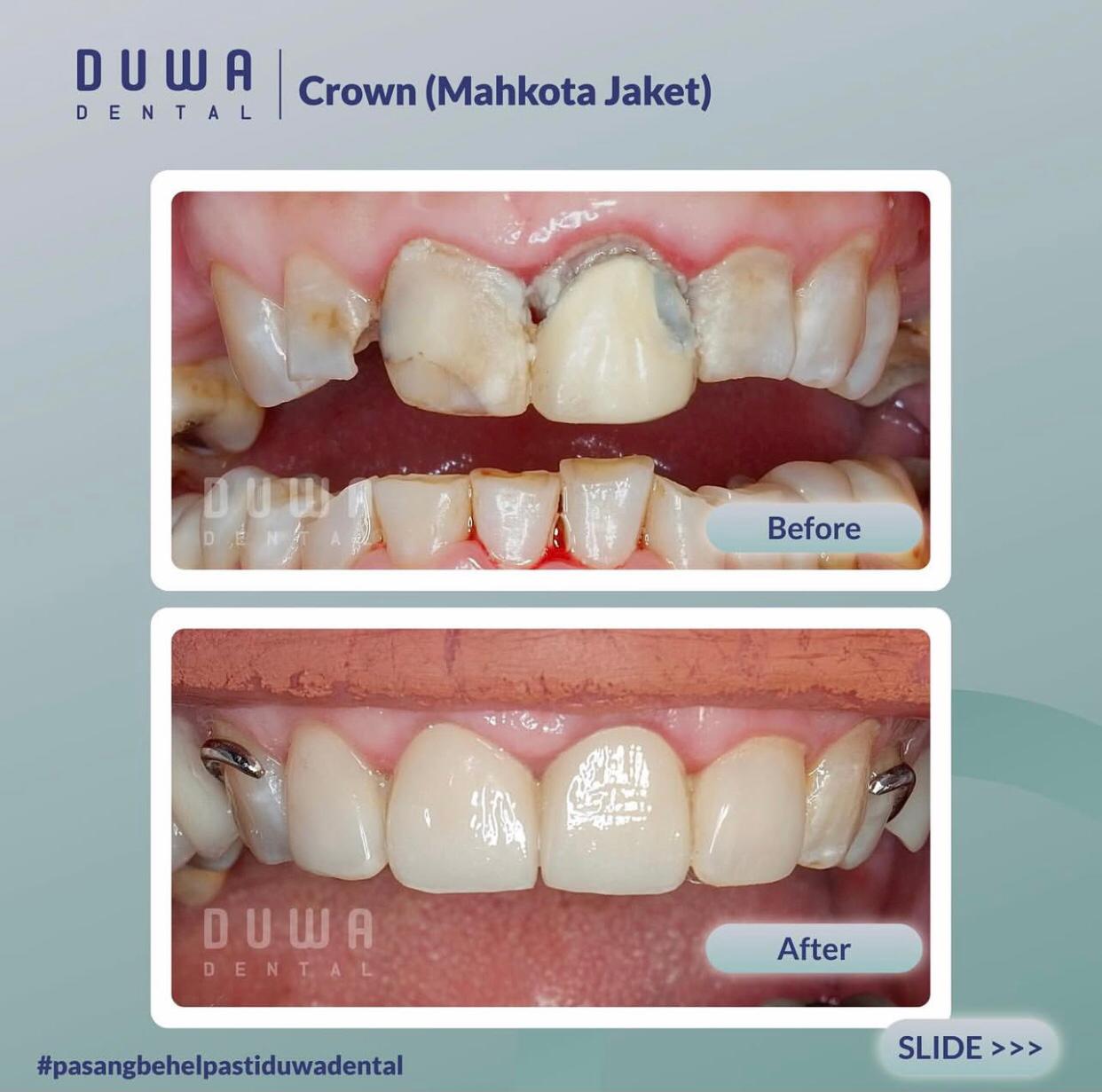 Crown (Mahkota Jaket)