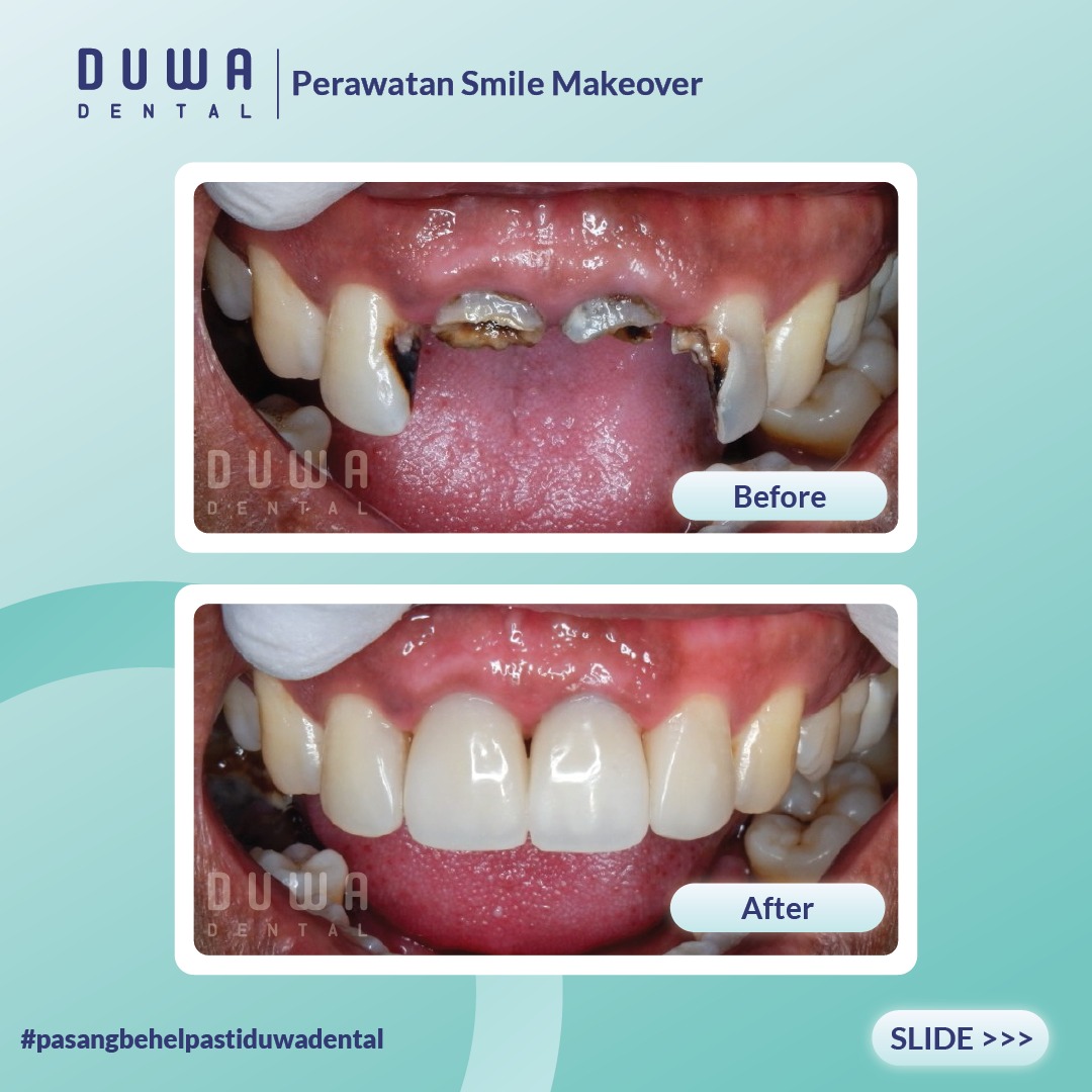 Perawatan Smile Make Over